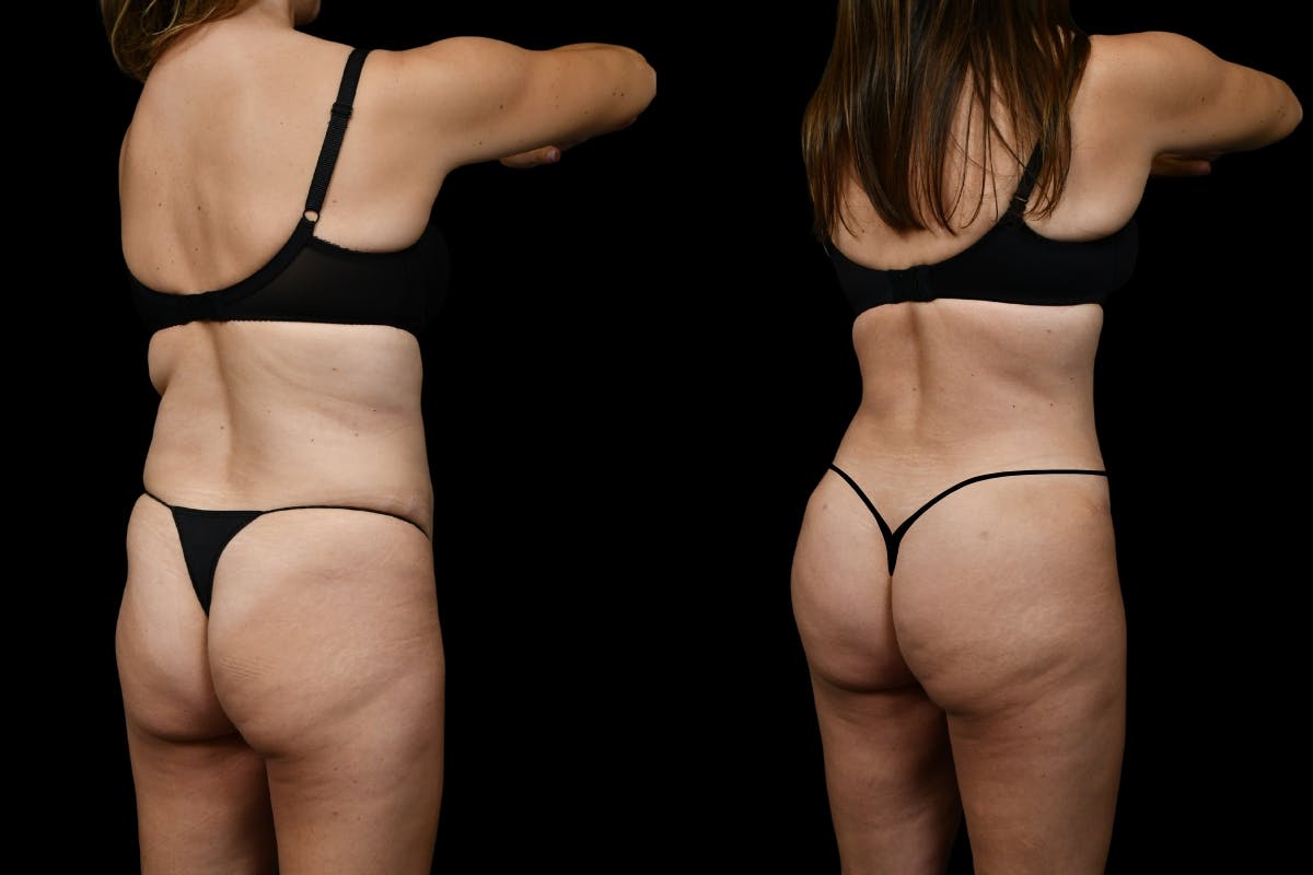 Tummy Tuck Before & After Gallery - Patient 193812 - Image 7