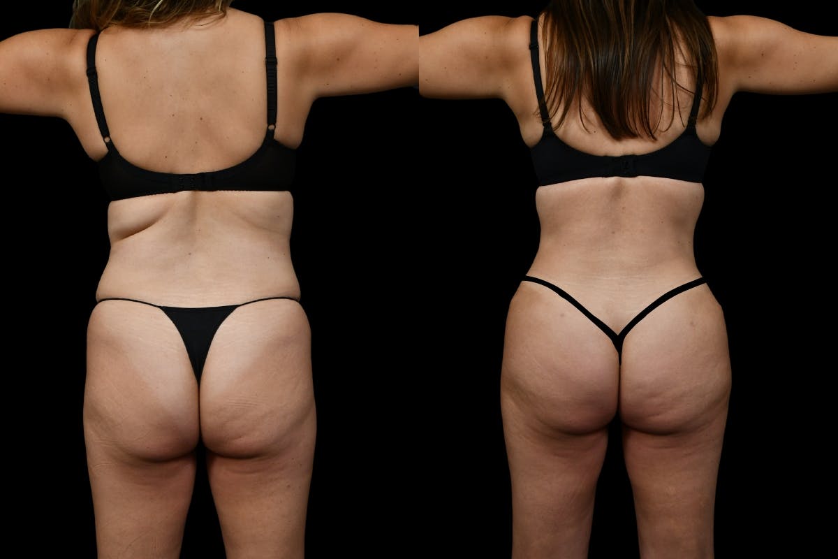 Tummy Tuck Before & After Gallery - Patient 193812 - Image 8