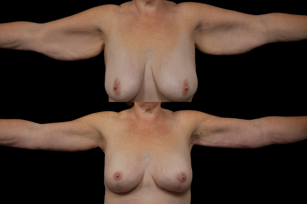 Arm Lift Before & After Gallery - Patient 148768 - Image 1
