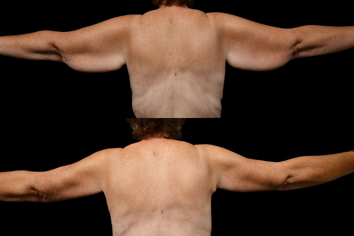 Arm Lift Before & After Gallery - Patient 148768 - Image 2
