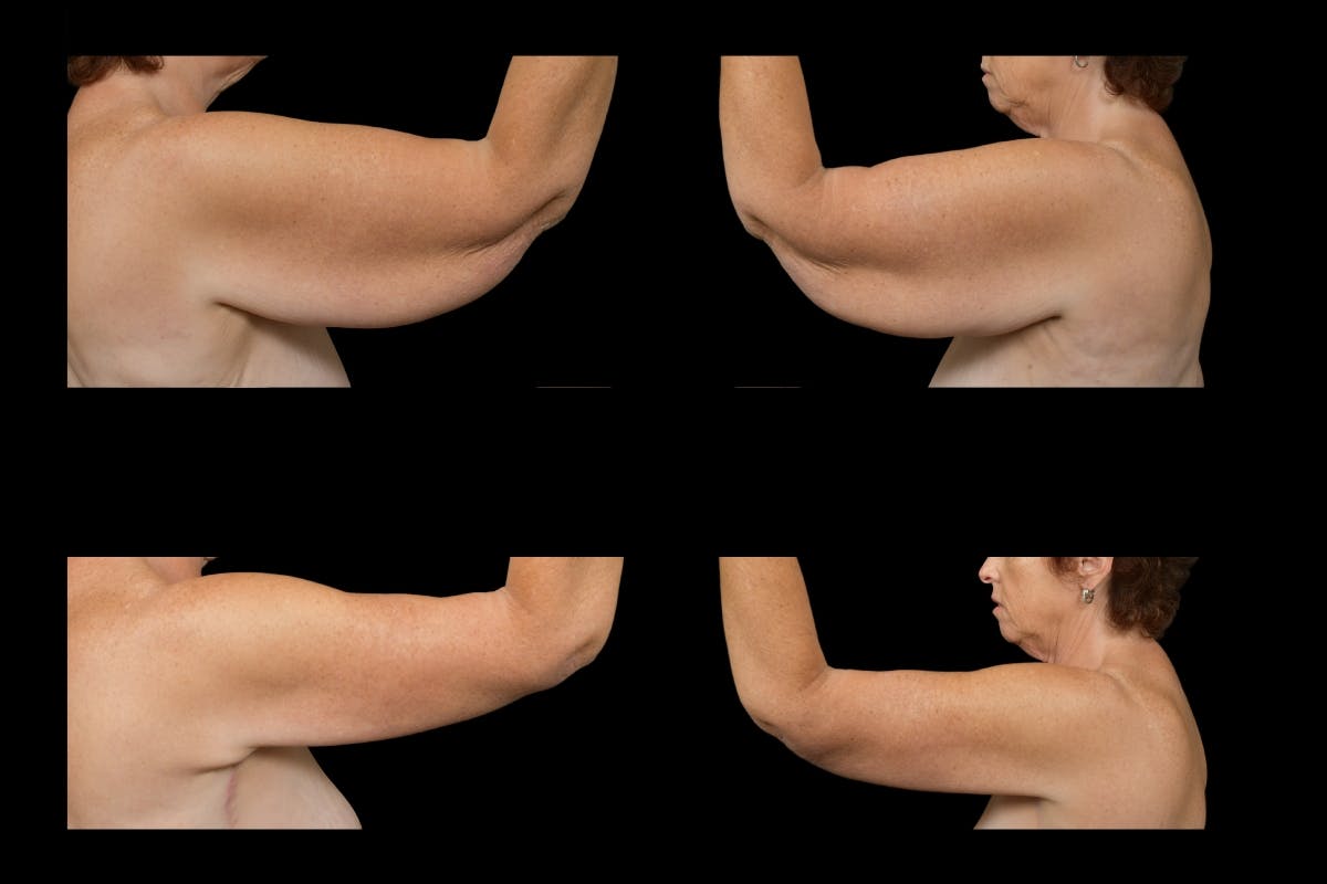 Arm Lift Before & After Gallery - Patient 148768 - Image 3
