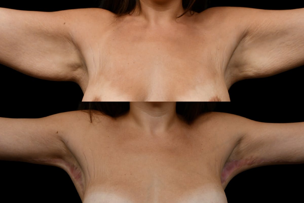 Arm Lift Before & After Gallery - Patient 260983 - Image 1