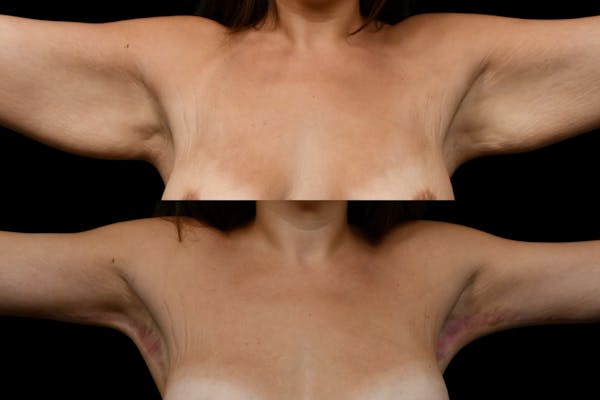Arm Lift Before & After Gallery - Patient 260983 - Image 1