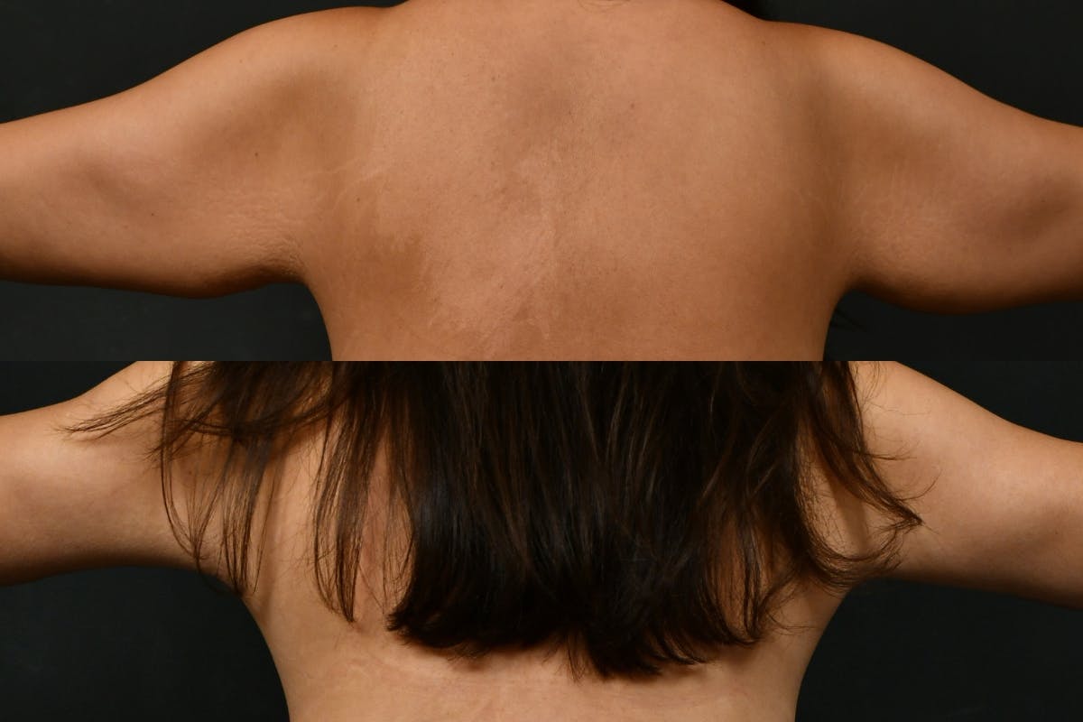 Arm Lift Before & After Gallery - Patient 260983 - Image 8