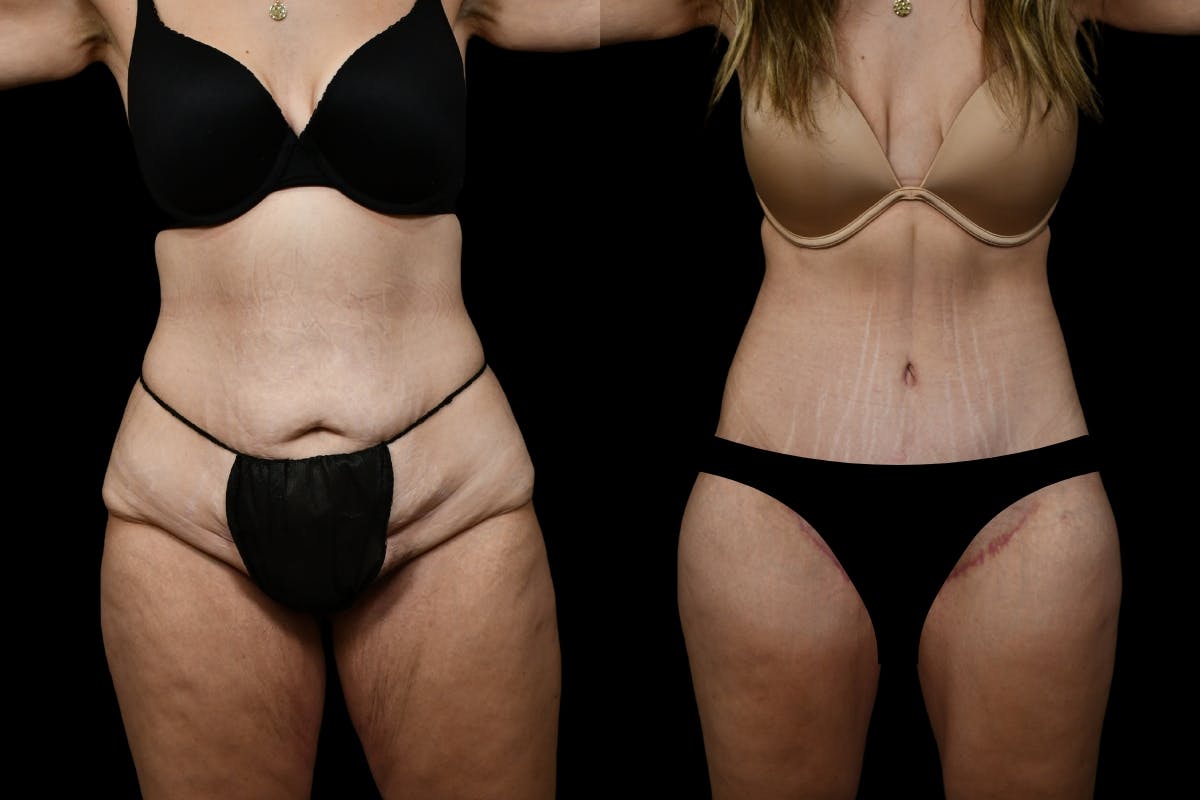 Thigh Lift Before & After Gallery - Patient 182942 - Image 1