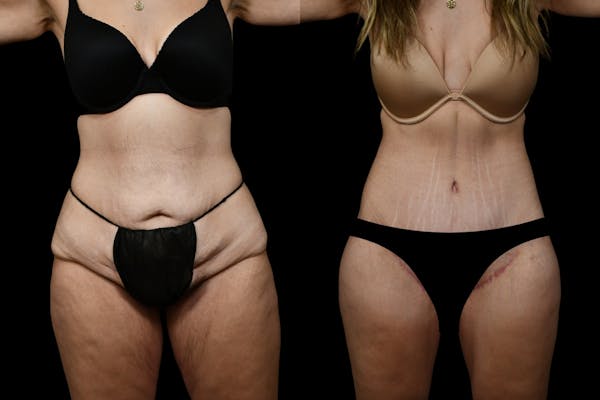 Thigh Lift Before & After Gallery - Patient 182942 - Image 1