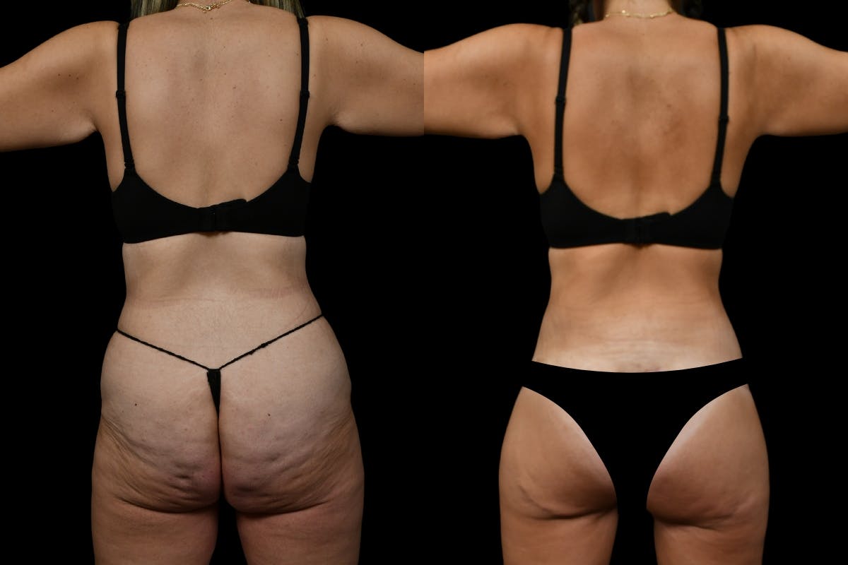Thigh Lift Before & After Gallery - Patient 182942 - Image 2