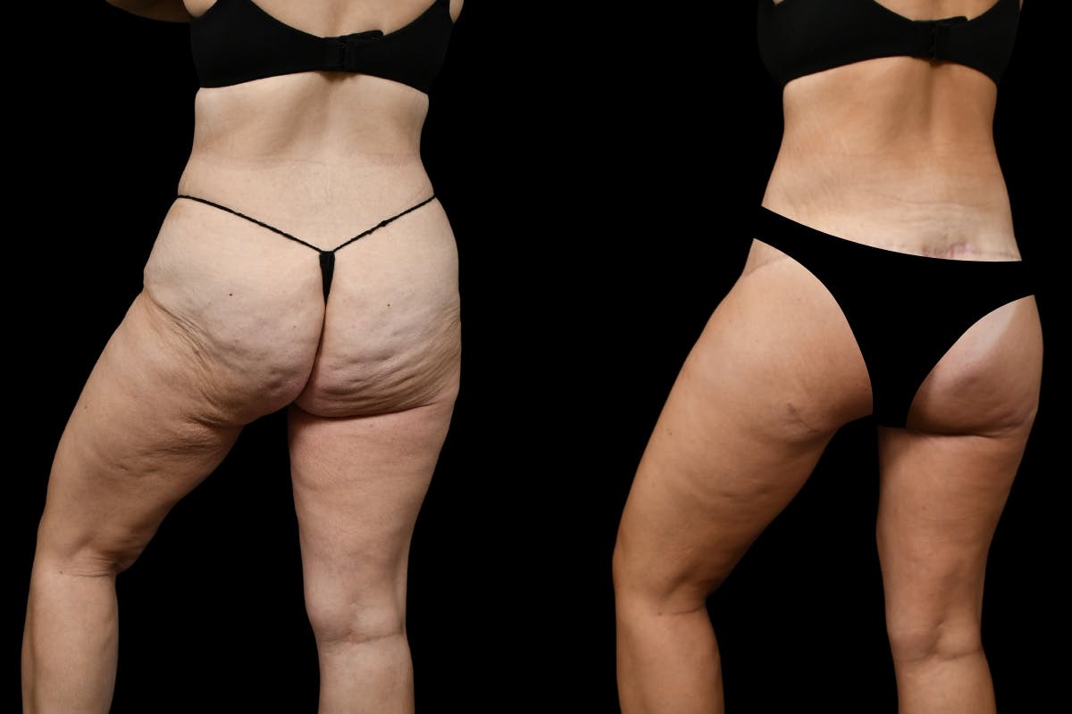 Thigh Lift Before & After Gallery - Patient 182942 - Image 3