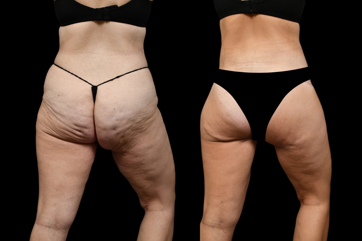 Thigh Lift Before & After Gallery - Patient 182942 - Image 4