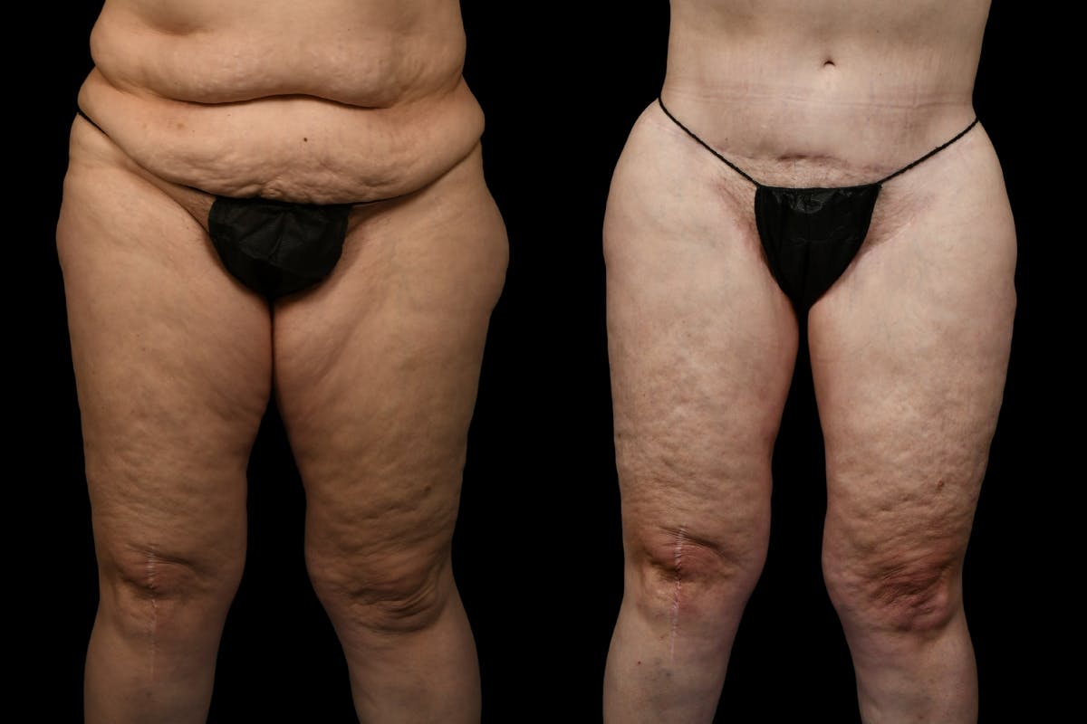 Thigh Lift Before & After Gallery - Patient 105130 - Image 1