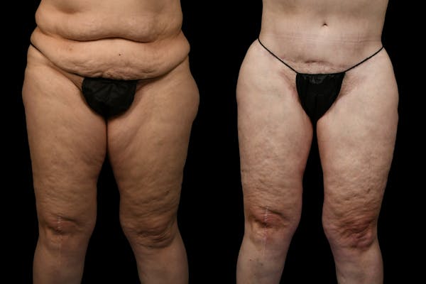 Thigh Lift Before & After Gallery - Patient 105130 - Image 1