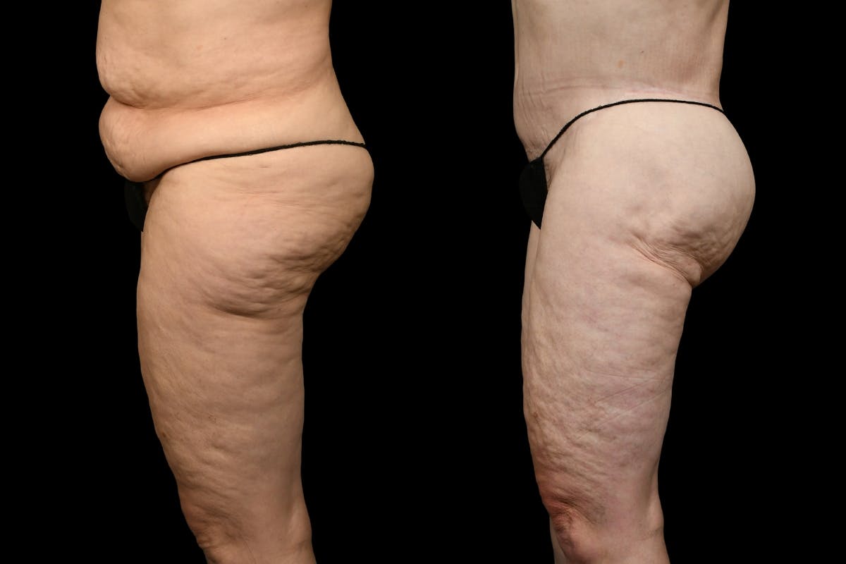 Thigh Lift Before & After Gallery - Patient 105130 - Image 4