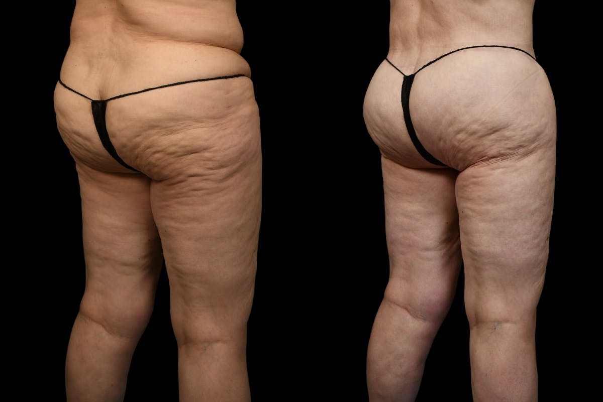 Thigh Lift Before & After Gallery - Patient 105130 - Image 6