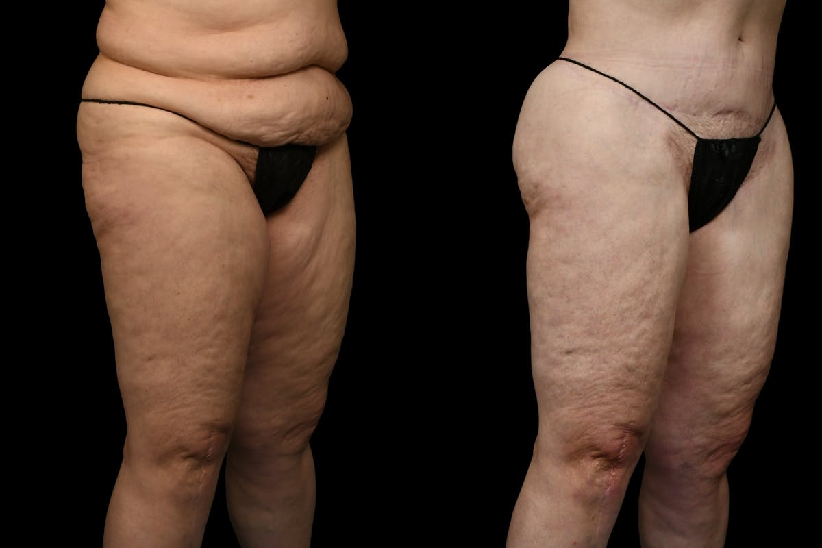 Thigh Lift Before & After Gallery - Patient 105130 - Image 7