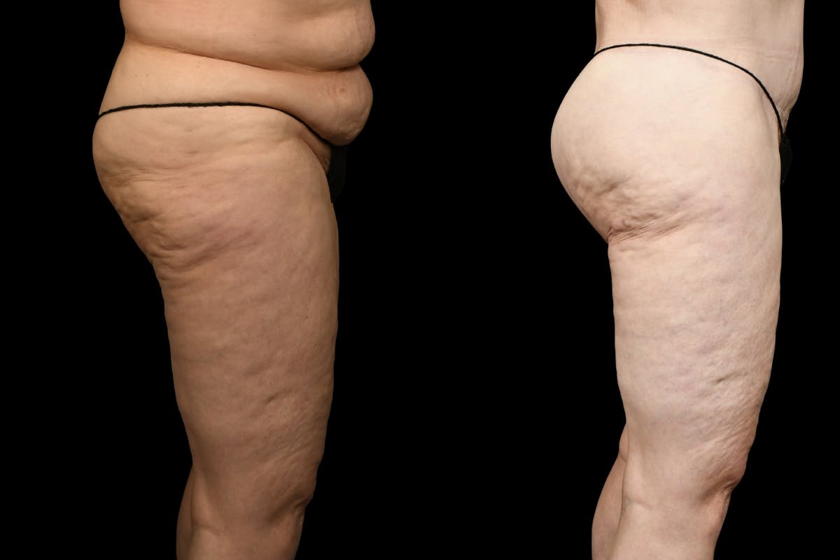 Thigh Lift Before & After Gallery - Patient 105130 - Image 8