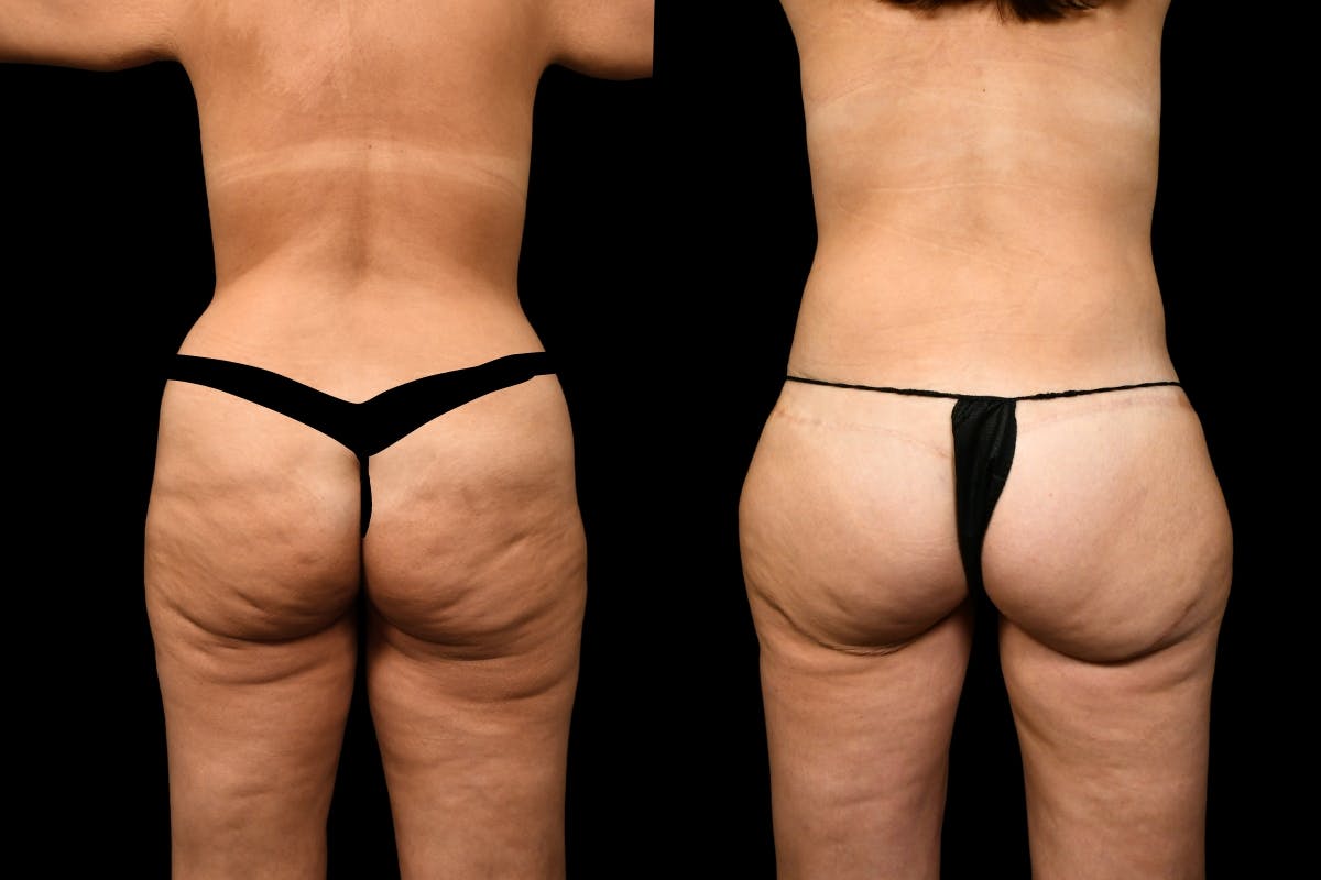 Thigh Lift Before & After Gallery - Patient 323244 - Image 2