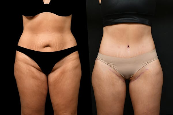 Thigh Lift Before & After Gallery - Patient 323244 - Image 1