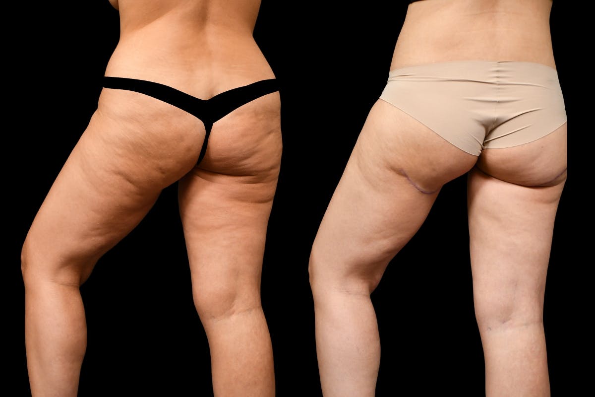 Thigh Lift Before & After Gallery - Patient 323244 - Image 3