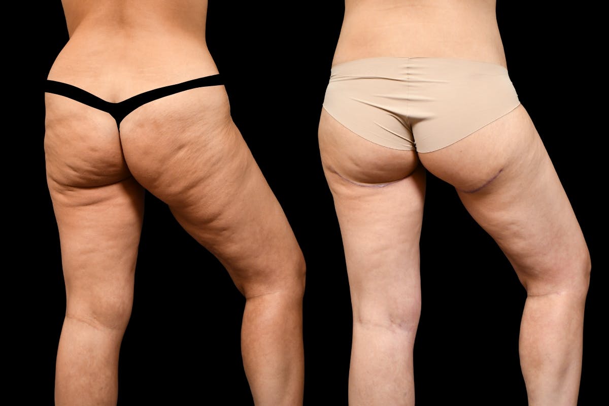 Thigh Lift Before & After Gallery - Patient 323244 - Image 4
