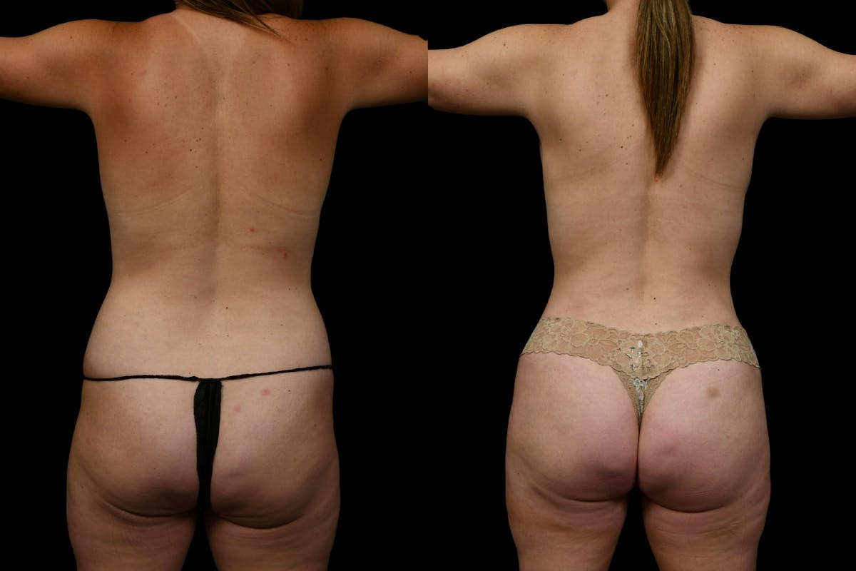 Mommy Makeover Before & After Gallery - Patient 312766 - Image 6