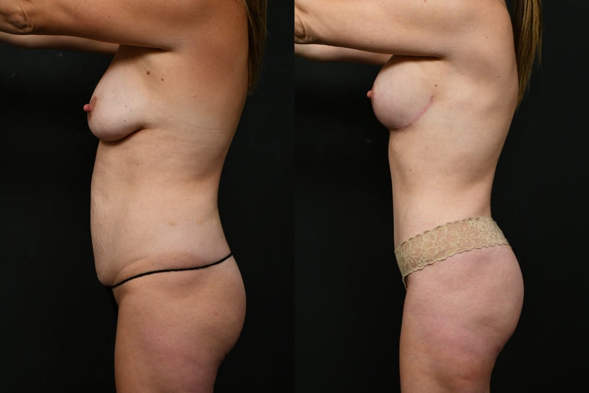 Tummy Tuck Before & After Gallery - Patient 268294 - Image 3