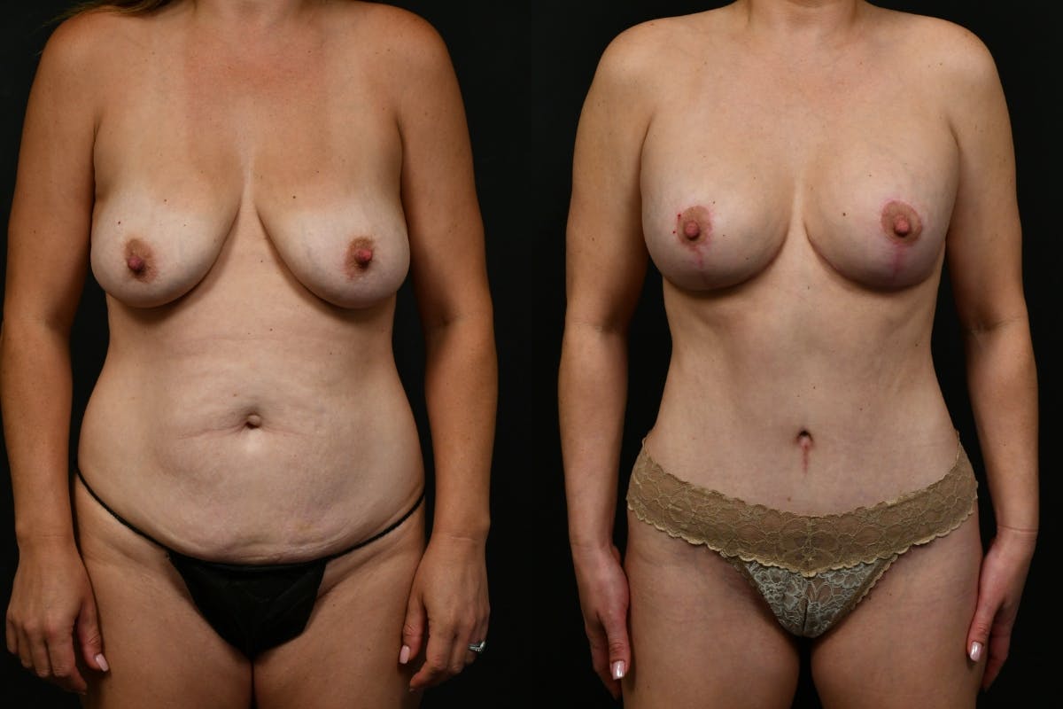 Tummy Tuck Before & After Gallery - Patient 268294 - Image 8
