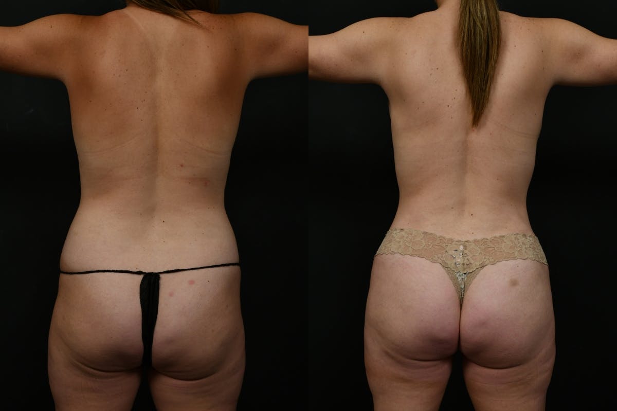 Tummy Tuck Before & After Gallery - Patient 268294 - Image 9