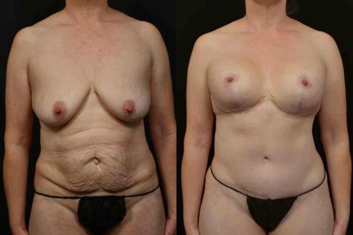 Breast Augmentation Before & After Gallery - Patient 750022 - Image 1
