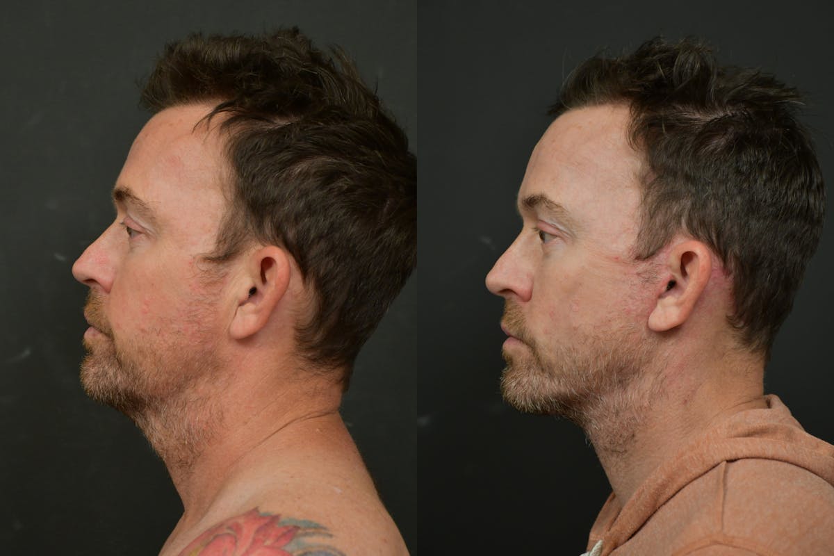 Changes Deep Plane Face Lift  Before & After Gallery - Patient 906278 - Image 2