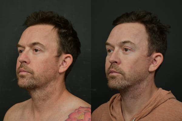 Changes Deep Plane Face Lift for Men Before & After Gallery - Patient 262467 - Image 1