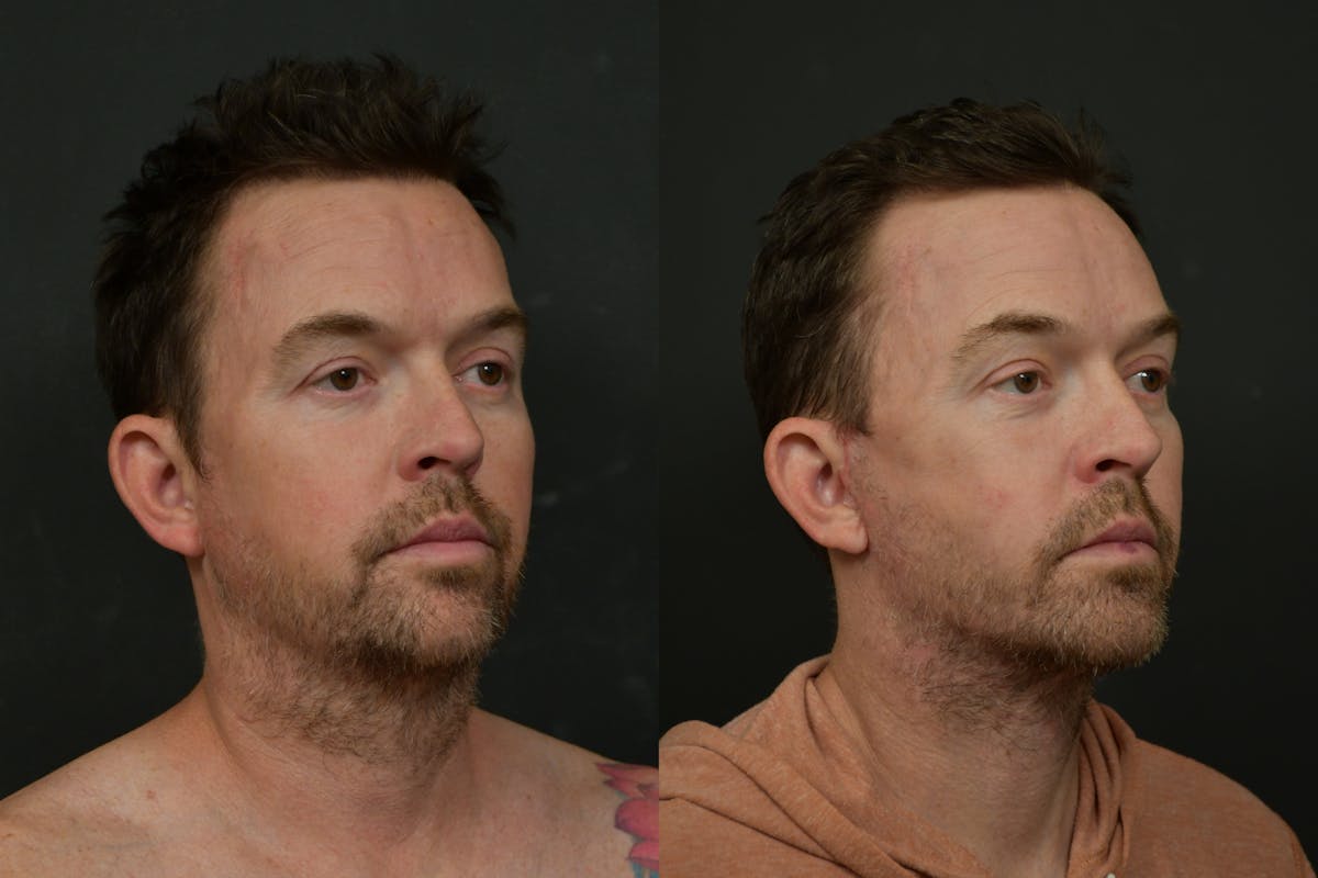 Changes Deep Plane Face Lift  Before & After Gallery - Patient 906278 - Image 4