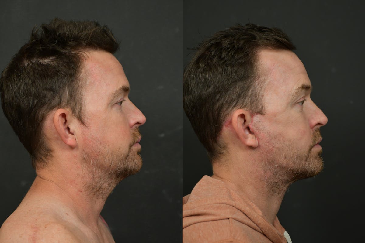Changes Deep Plane Face Lift  Before & After Gallery - Patient 906278 - Image 3