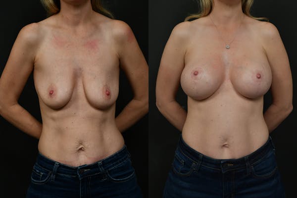 Breast Augmentation Before & After Gallery - Patient 260072 - Image 1