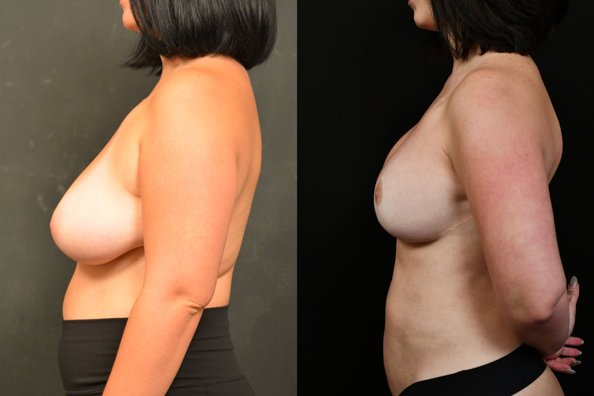 Breast Reduction Before & After Gallery - Patient 147915 - Image 5
