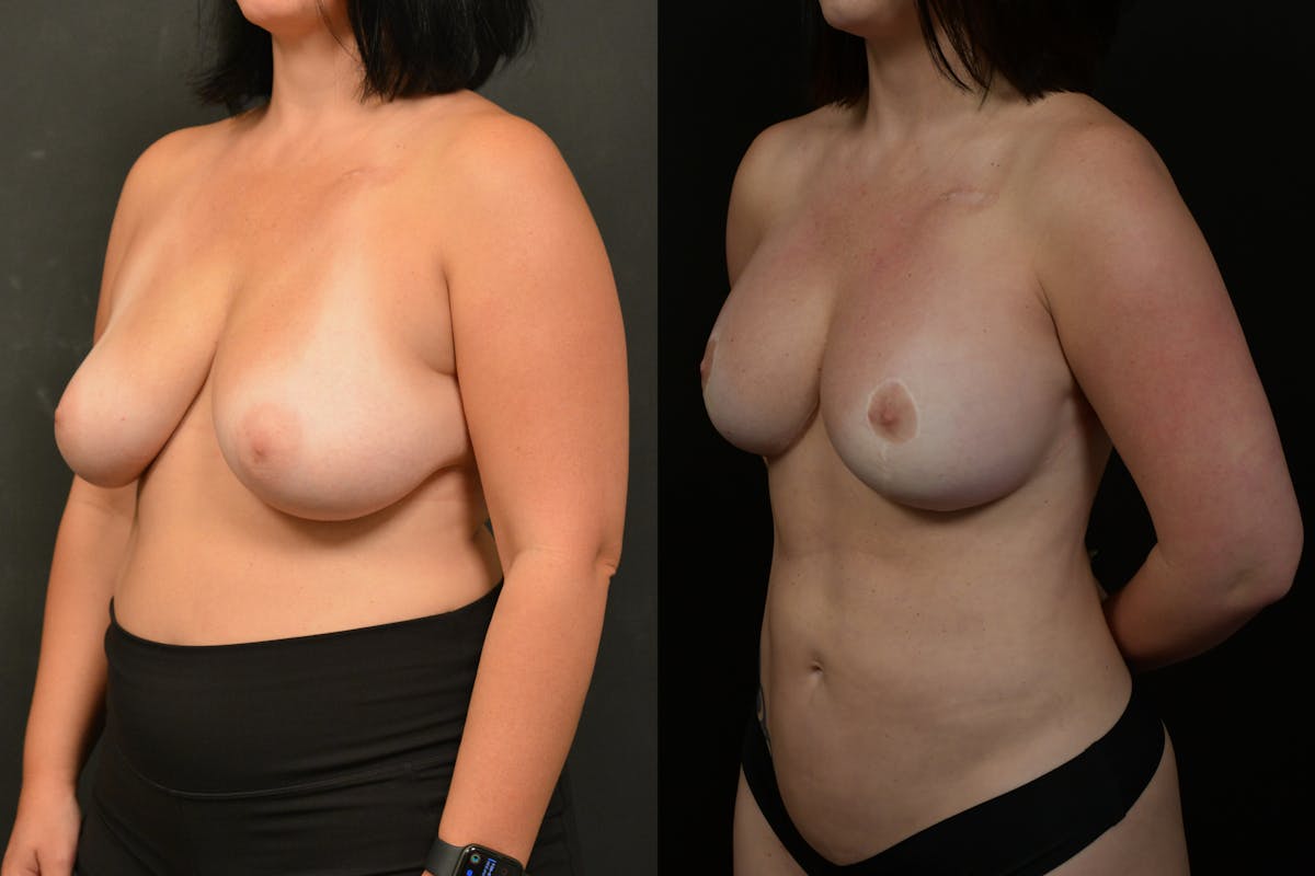 Breast Reduction Before & After Gallery - Patient 147915 - Image 4