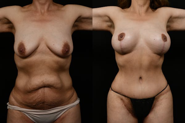 Tummy Tuck Before & After Gallery - Patient 293018 - Image 1