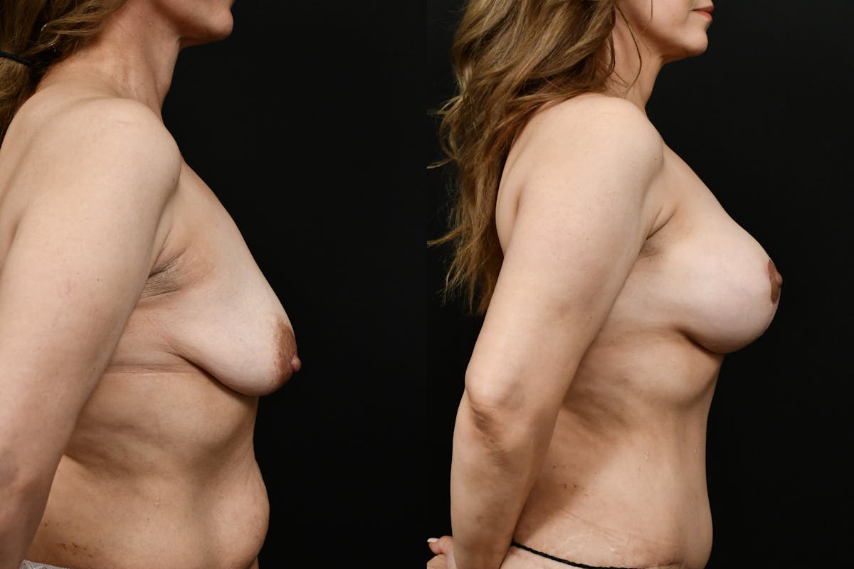 Breast Lift Before & After Gallery - Patient 834632 - Image 3
