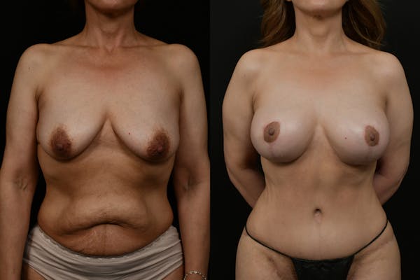 Breast Augmentation Before & After Gallery - Patient 375025 - Image 1