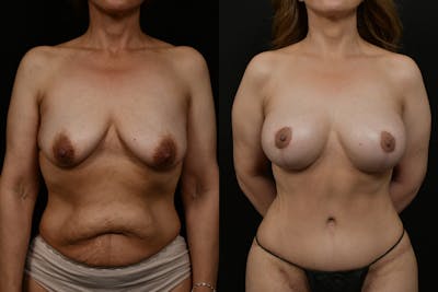 Mommy Makeover Before & After Gallery - Patient 545804 - Image 1