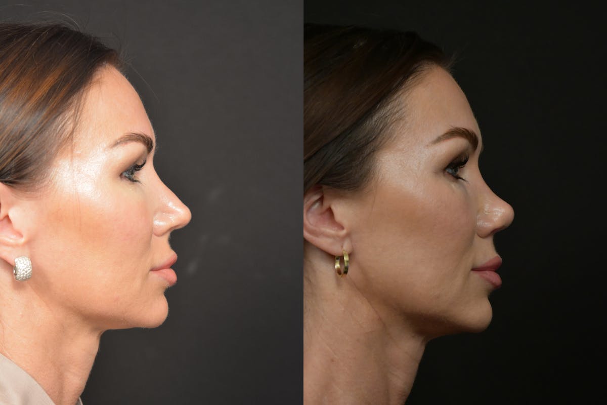 Rhinoplasty Before & After Gallery - Patient 232250 - Image 4