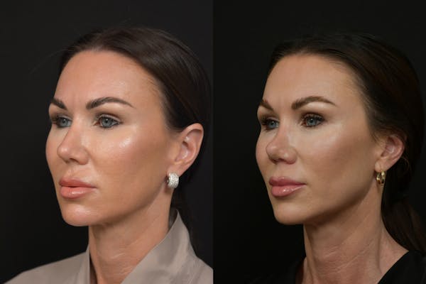 Rhinoplasty Before & After Gallery - Patient 232250 - Image 1