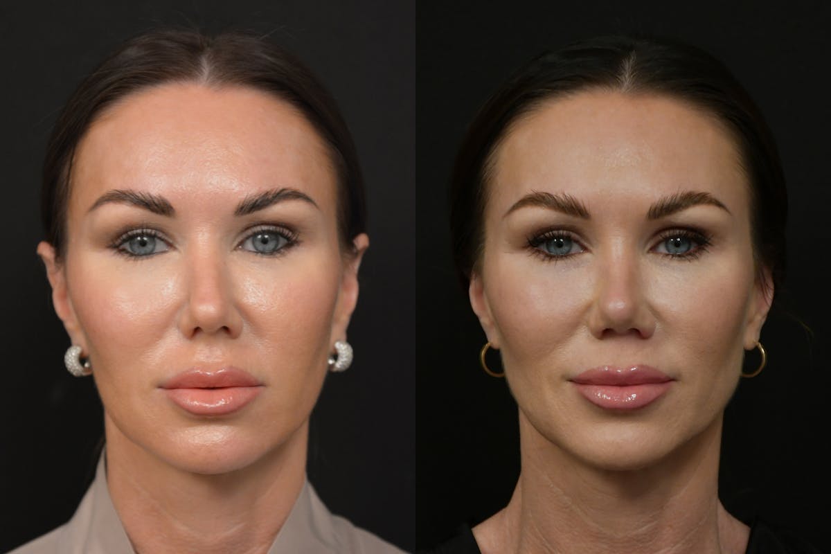 Rhinoplasty Before & After Gallery - Patient 232250 - Image 5