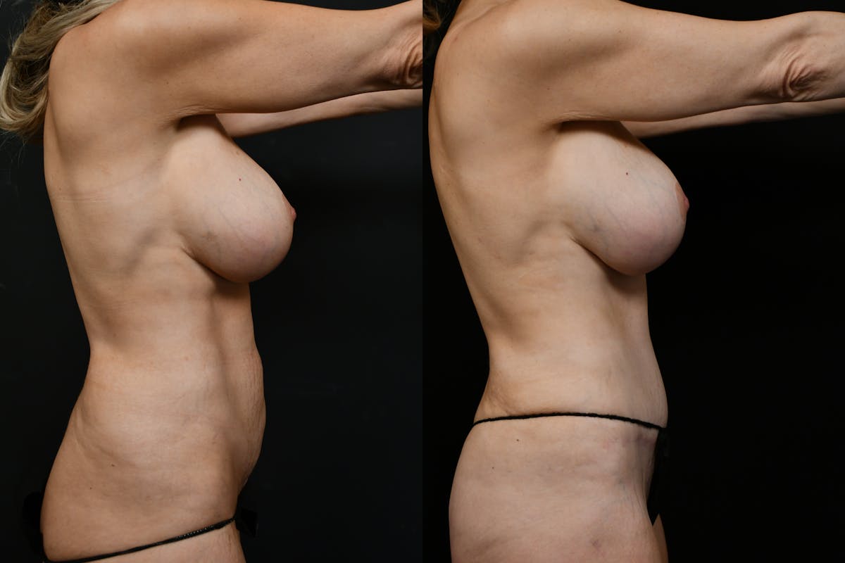Liposuction / BodyTite Before & After Gallery - Patient 361330 - Image 6