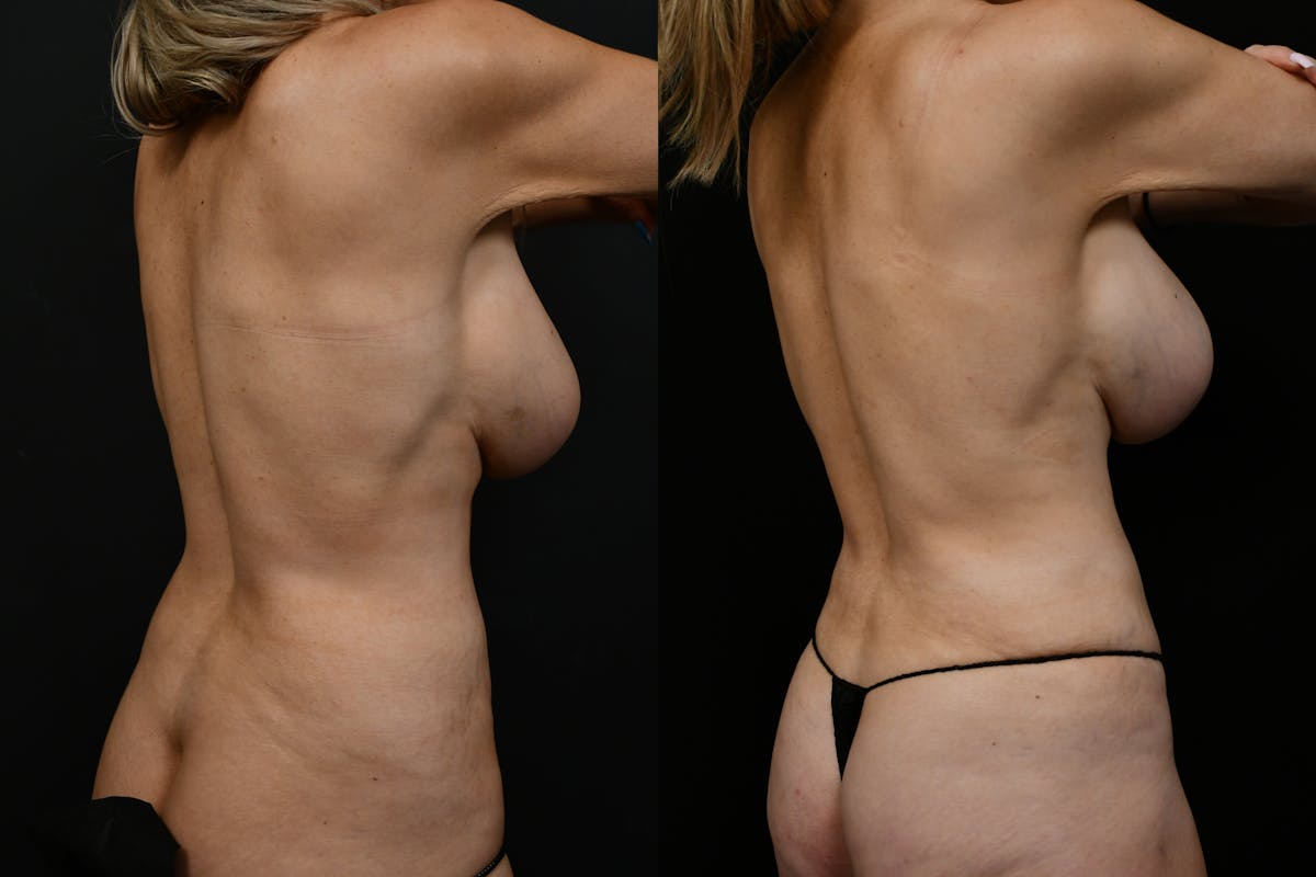 Liposuction / BodyTite Before & After Gallery - Patient 361330 - Image 4