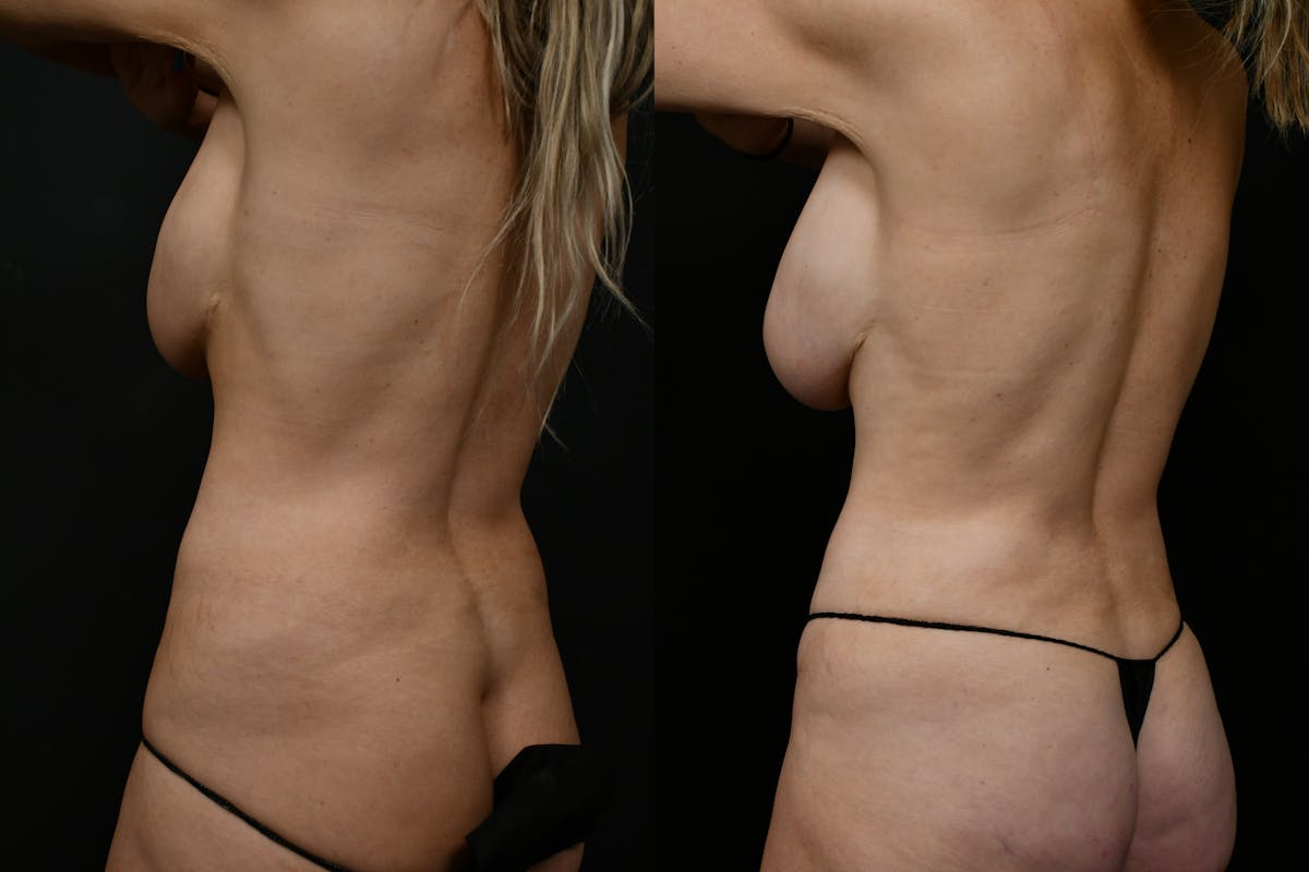 Tummy Tuck Before & After Gallery - Patient 192043 - Image 6
