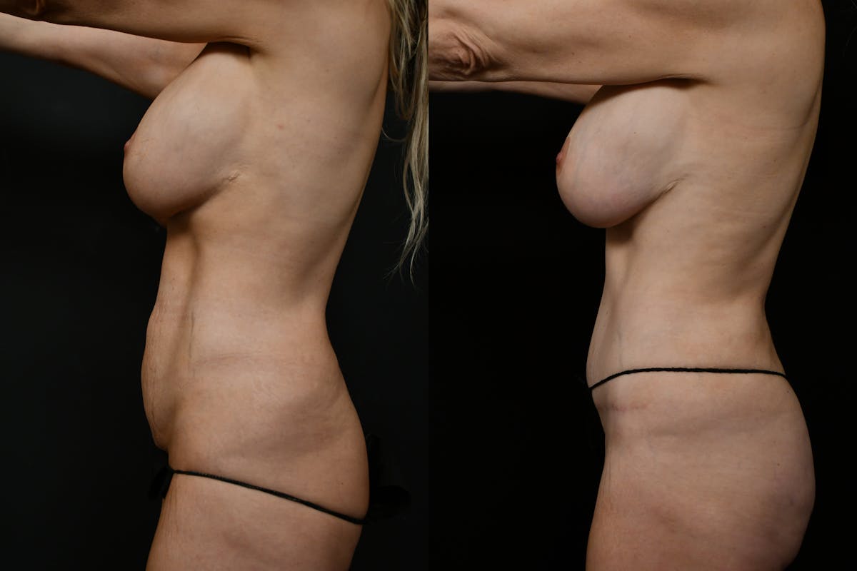 Liposuction / BodyTite Before & After Gallery - Patient 361330 - Image 3