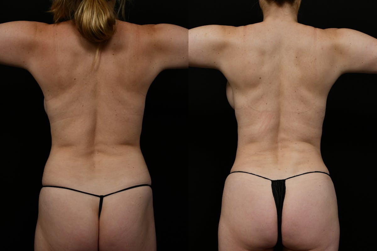 Liposuction / BodyTite Before & After Gallery - Patient 332569 - Image 4