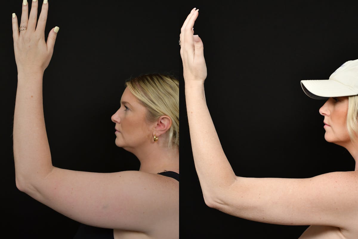 Liposuction / BodyTite Before & After Gallery - Patient 922880 - Image 1