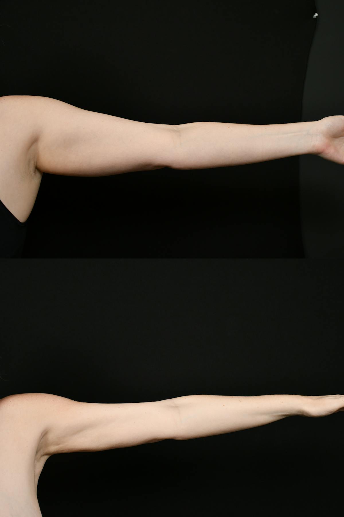 Liposuction / BodyTite Before & After Gallery - Patient 922880 - Image 3