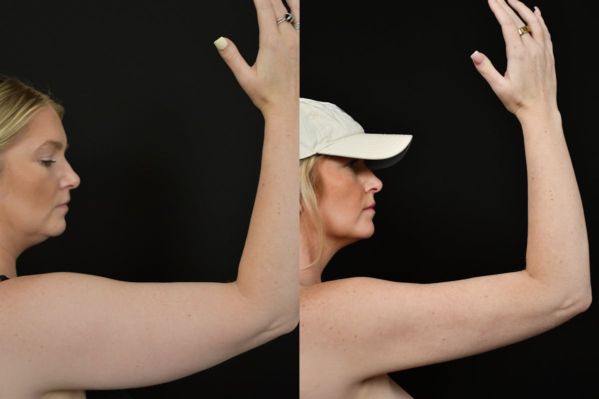 Liposuction / BodyTite Before & After Gallery - Patient 922880 - Image 2